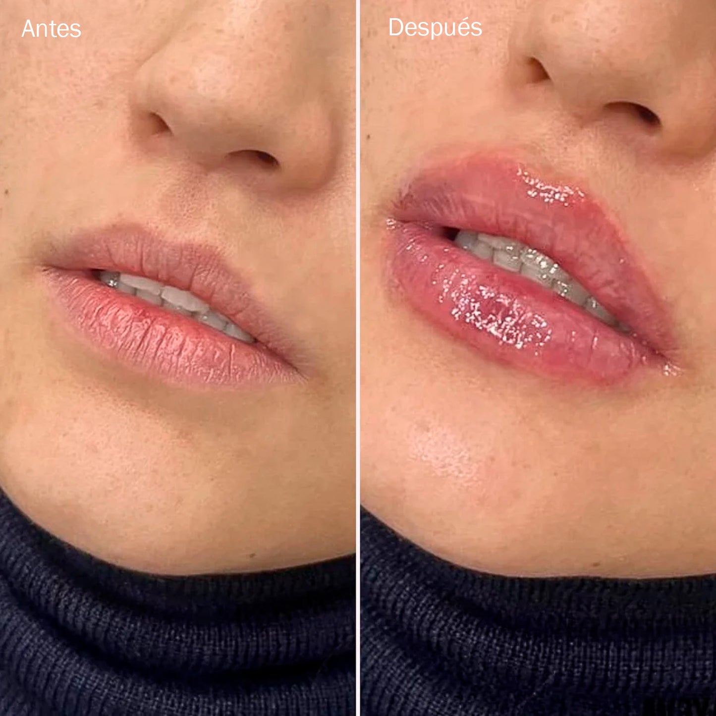 Kora Lip | Gloss Voluminizador