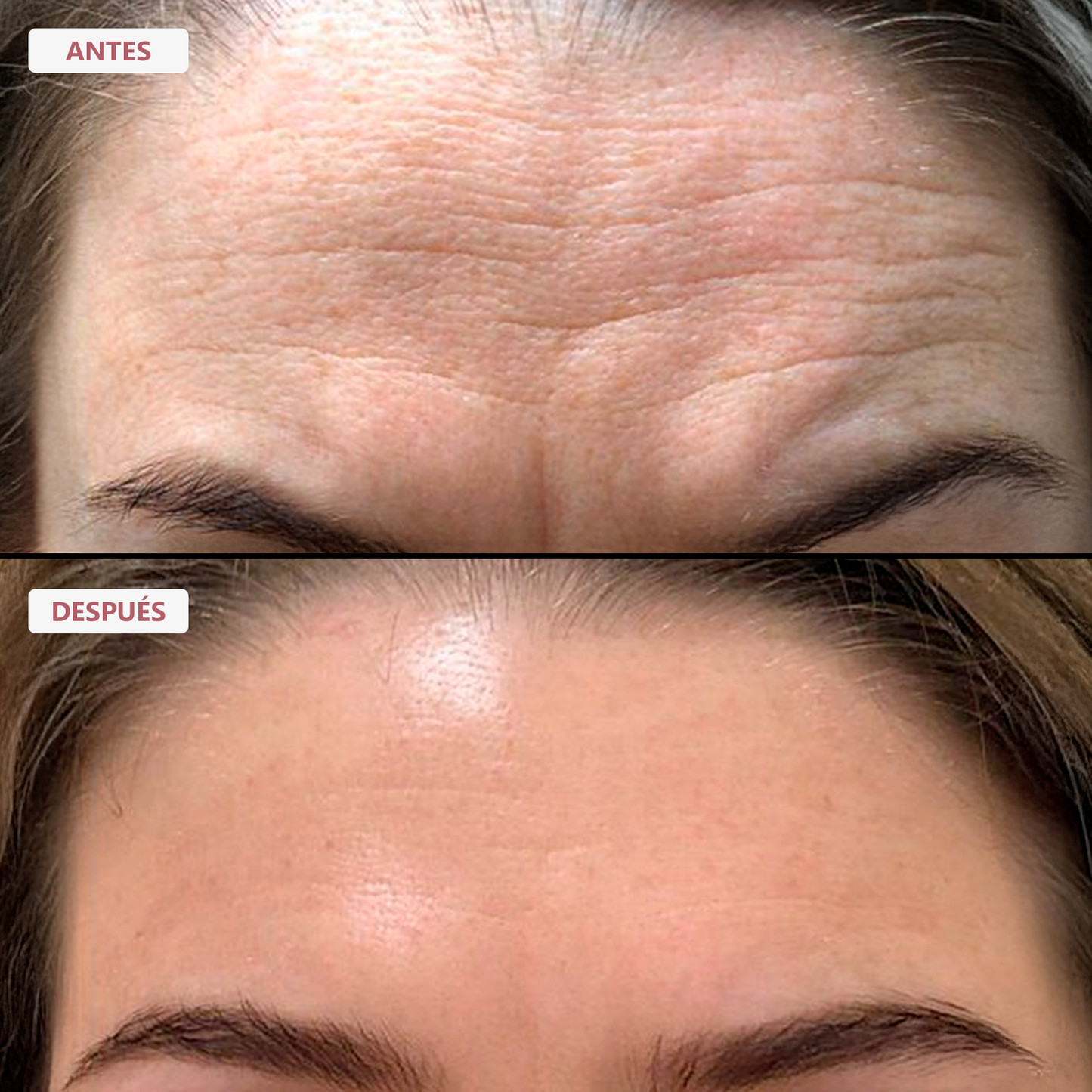 Serum de PDRN con Micro Agujas