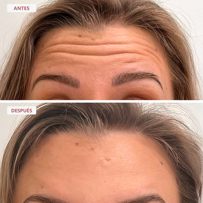 Serum de PDRN con Micro Agujas