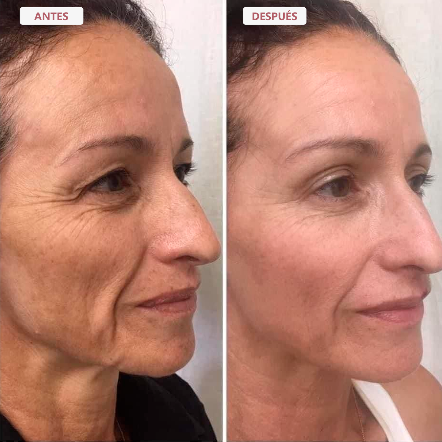 Serum de PDRN con Micro Agujas
