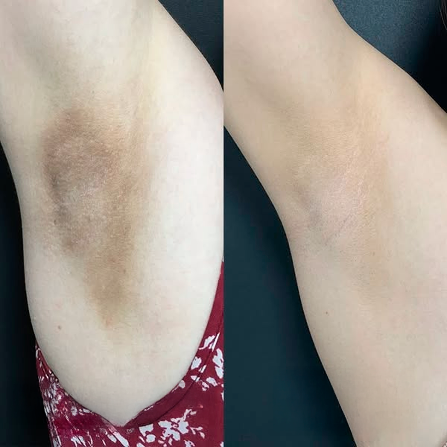 JIYU | PADS COREANOS ACLARA AXILAS